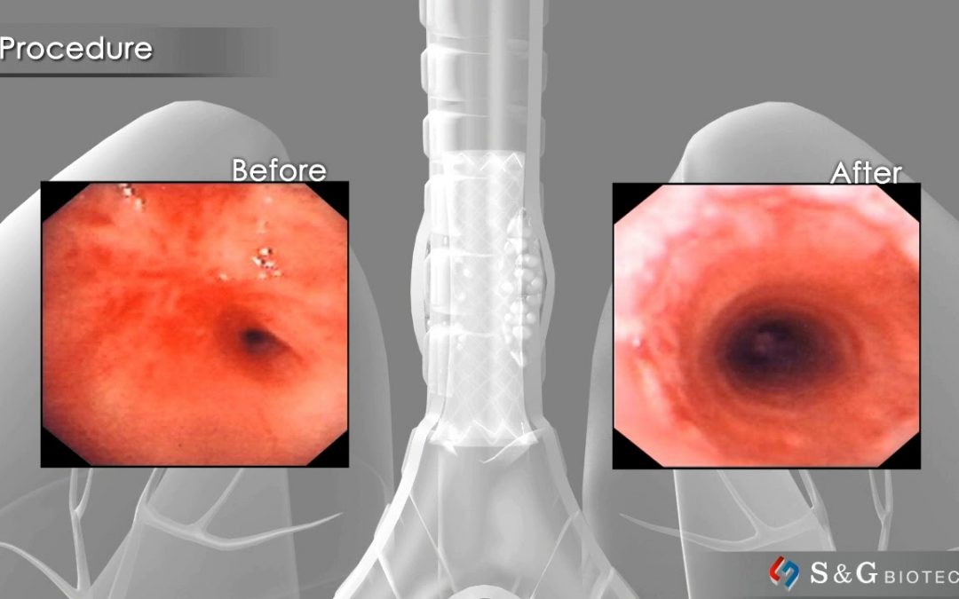 S&G Biotech EGIS Airway stent