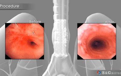 S&G Biotech EGIS Airway stent