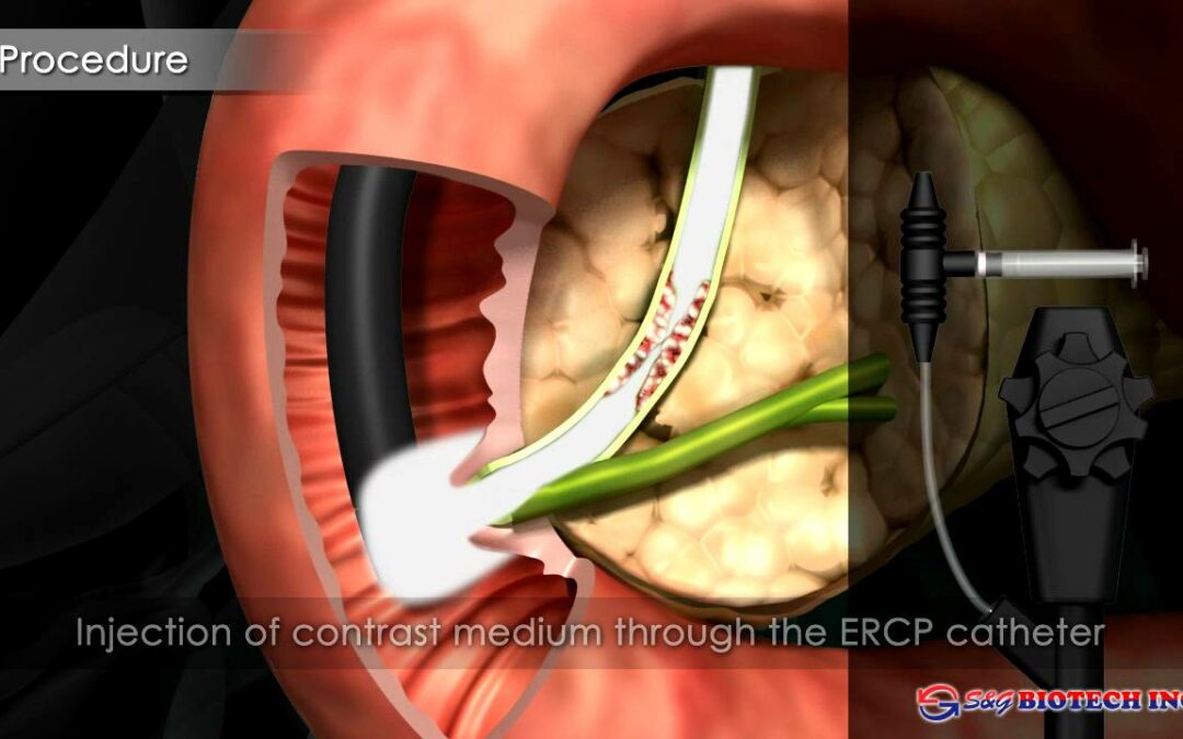 S&B Biotech EGIS Biliary stent