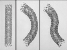 Case_A Double-Layered Covered Biliary Metal Stent