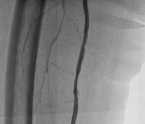 Case_treatment with e-PTFE stent-graft