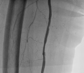 Case_treatment with e-PTFE stent-graft