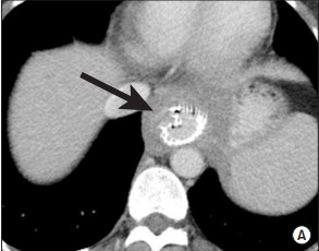 Case_Esophageal stents: Beyond the simple stricture