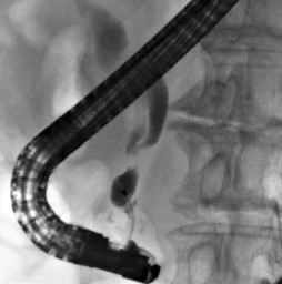 Case_Predictive factors for pancreatitis and cholecystitis in endoscopic covered metal stenting